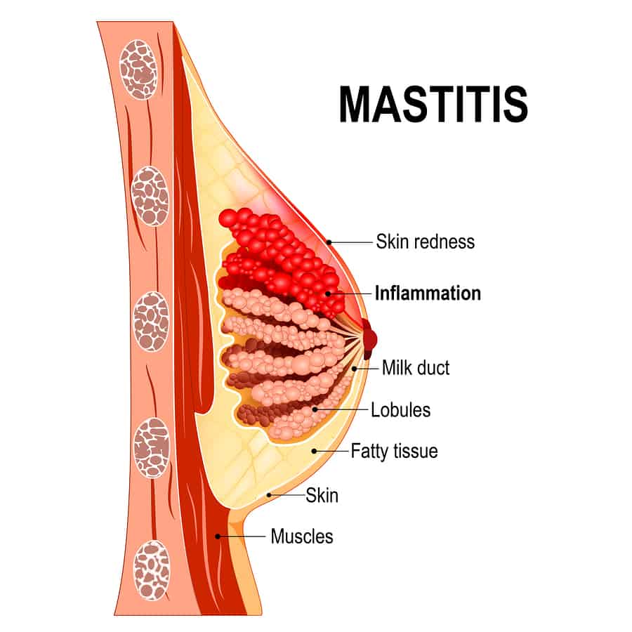 Mastitis in the breast