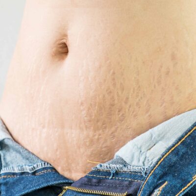 Stretch Marks And The Causes Of It