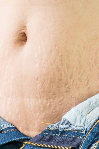 Causes of stretch mars during pregnancy